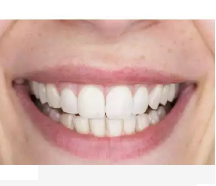 Depois do tratamento de clareamento