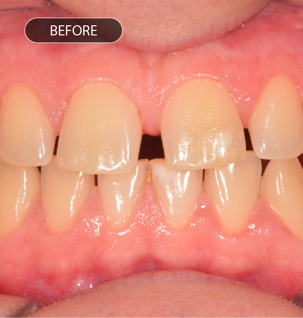 Antes do tratamento de ortodontia