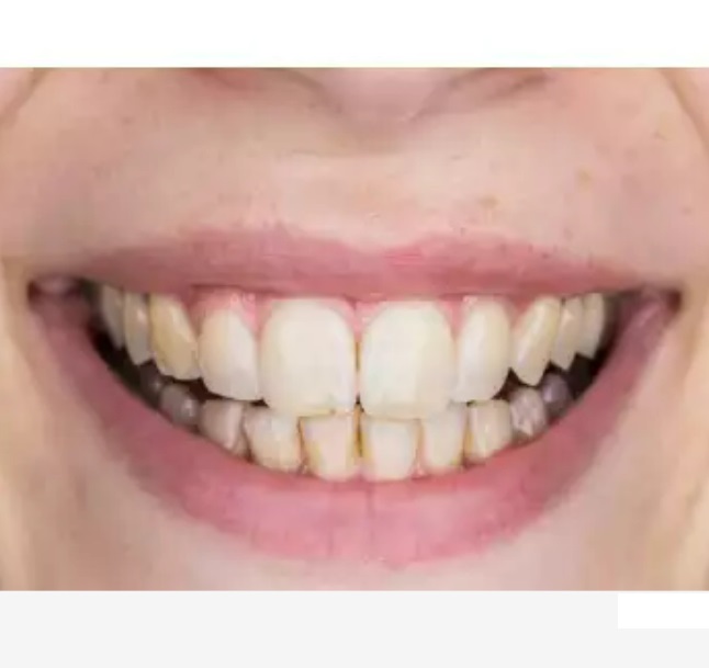 Antes do tratamento de clareamento